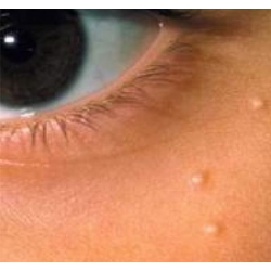Steps to Use Apple Cider Vinegar for Skin Tag Removal